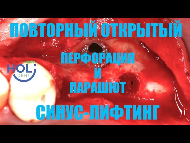 Повторный открытый синус-лифтинг, перфорация и парашют