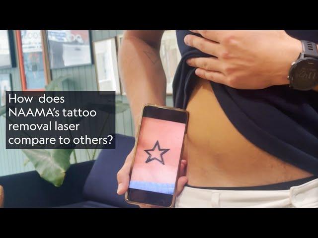 Jack's Experience Getting His Tattoo Removed by NAAMA the Leading Tattoo Removal Studio in London