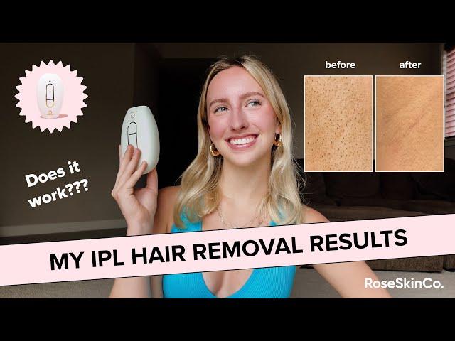 Lumi LASER HAIR REMOVAL Review & 1 Month Results! (ft. RoseSkinCo)