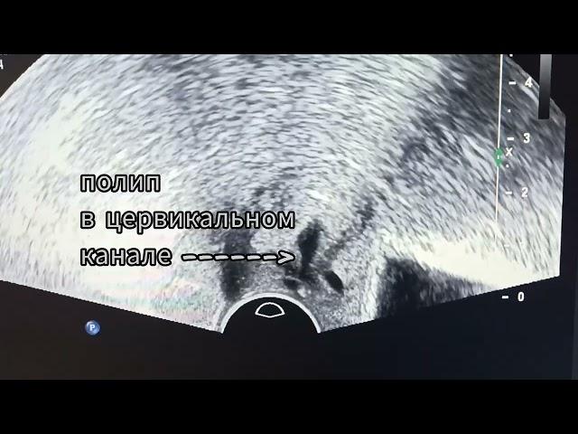 полип шейки матки (полип цервикального канала, cervical canal polyp)