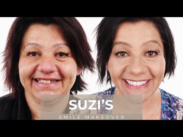 Suzi's Dental Smile Make-over Journey | Dental Boutique