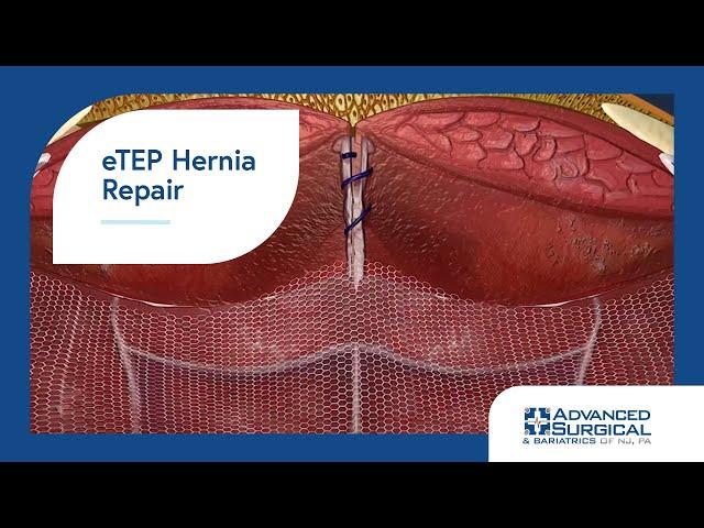 eTEP Hernia Repair