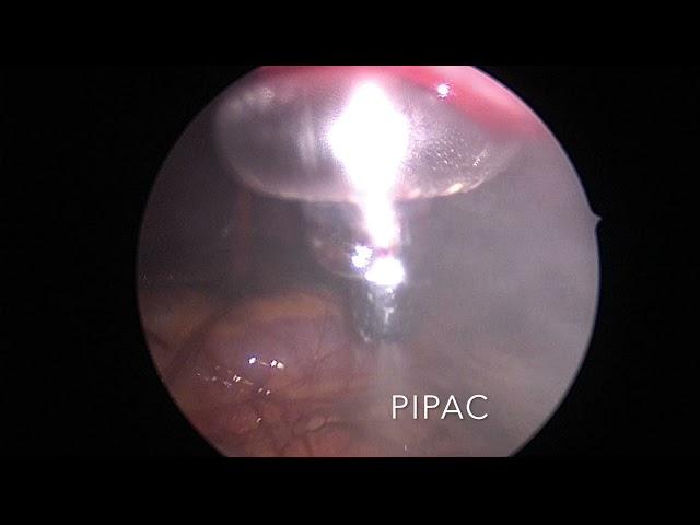 PIPAC treatment for advanced Peritoneal stage 4 cancers, Dr Sanjeev Kumar Oncologist Delhi NCR India