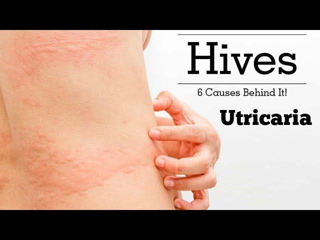 Urticaria Hives डाबर आउने समस्या के हो ? || Dr.Rupak Ghimire