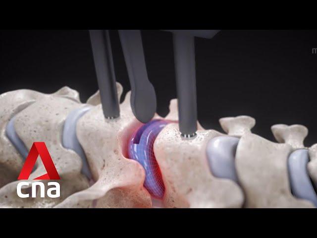 New minimally invasive disc replacement surgical technique for elderly patients with osteoporosis