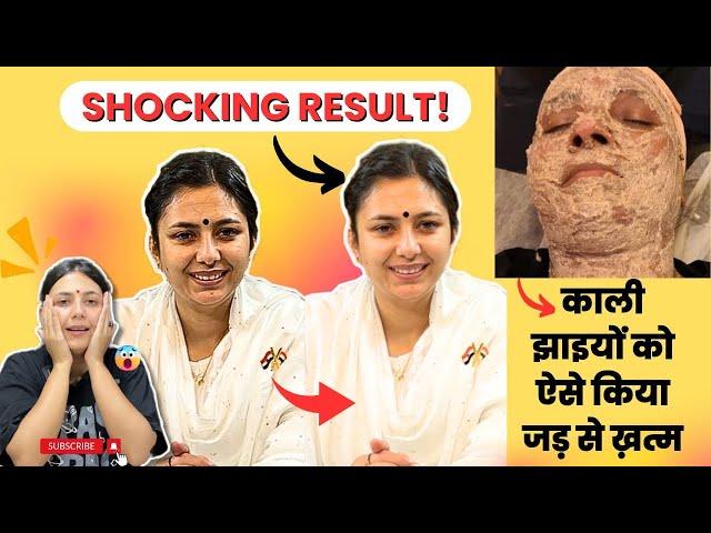 Jhaiyo ka 100% Permanent ilaaj | Pigmentation, Melasma Remedy | Skin Whitening Home Remedies