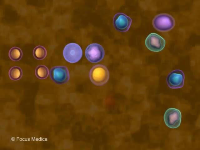 Acute lymphoblastic leukemia - Hematology