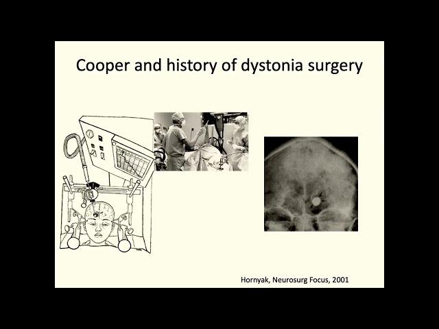 CNS Neurosurgery 100: Neurosurgery for Dystonias