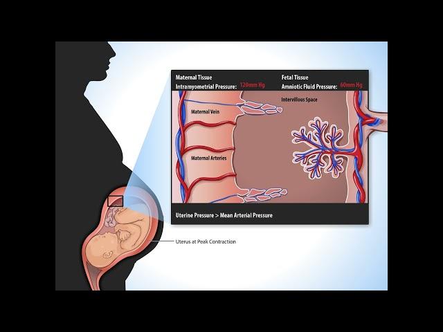 Uterine Contractions - Fundamentals of Fetal Health Surveillance