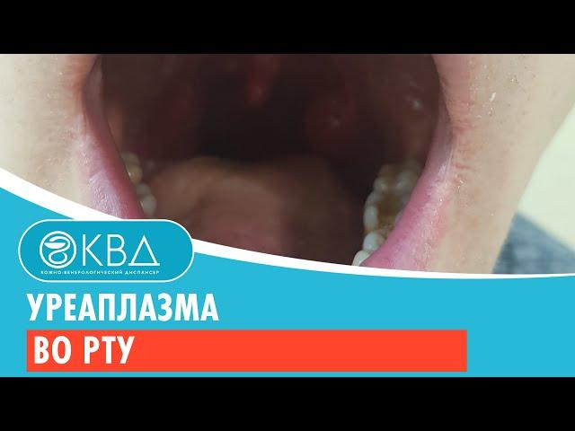  Уреаплазма во рту. Клинический случай №297