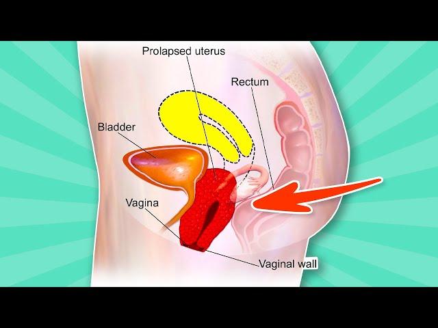  UTERINE PROLAPSE Treatment At Home  5 Easy Exercises