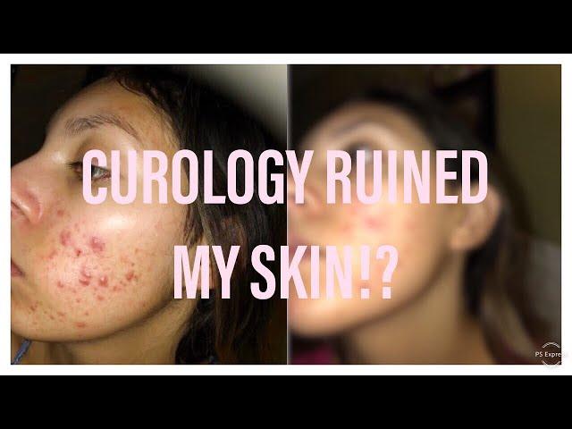 CUROLOGY MADE MY ACNE WORSE?! I Honest 5 Month Review