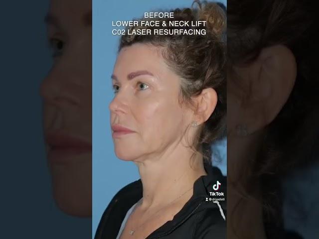 Before and After Facial Plastic Surgery #beforeandafter #plasticsurgery #facelift #co2laser