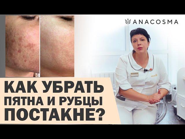 ПОСТАКНЕ  КАК УБРАТЬ ПЯТНА И РУБЦЫ ПОСЛЕ ВЫСЫПАНИЙ? | Федоряченко Оксана