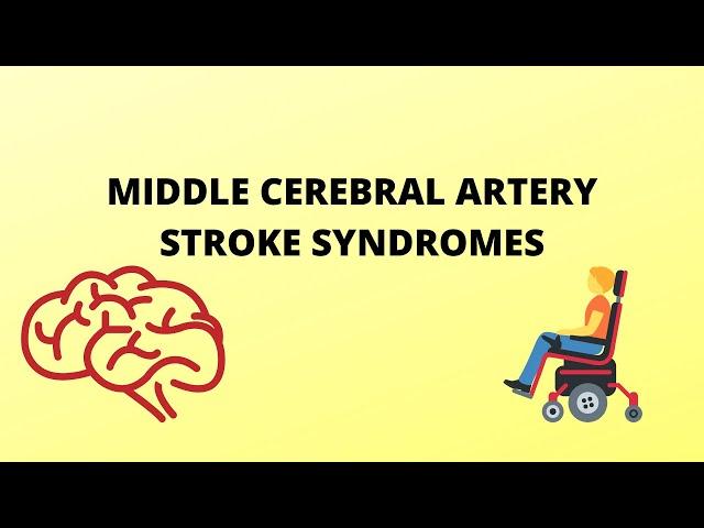 Middle Cerebral Artery Stroke Syndromes | Anatomy | Clinical features |