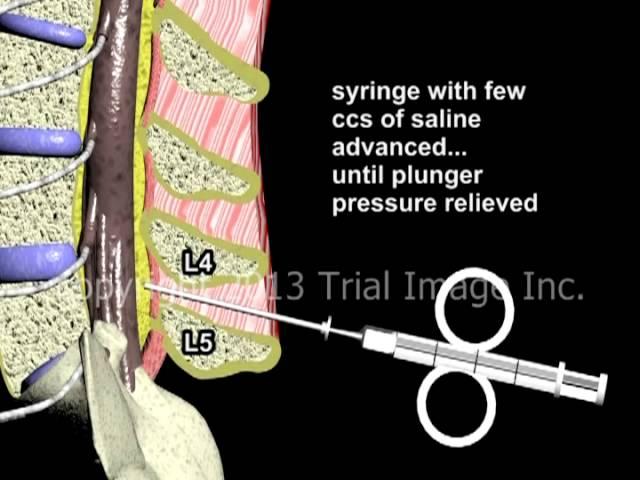 Epidural Spinal Anesthesia - Animation by Dr. Cal Shipley, M.D.