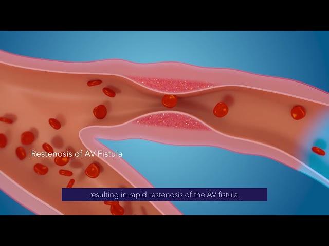 Medtronic's IN.PACT™ AV Access Trial - 3 yrs results