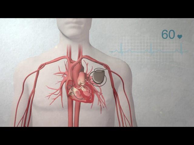 What is a pacemaker