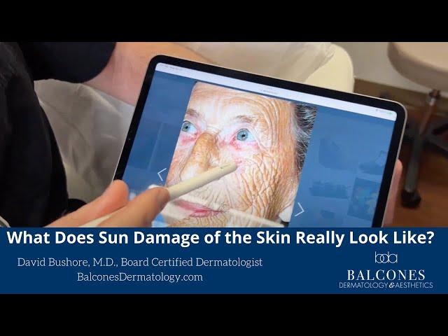 What Does Sun Damage of the Skin Really Look Like? | David Bushore, MD, FAAD | Ph: 512-459-4869