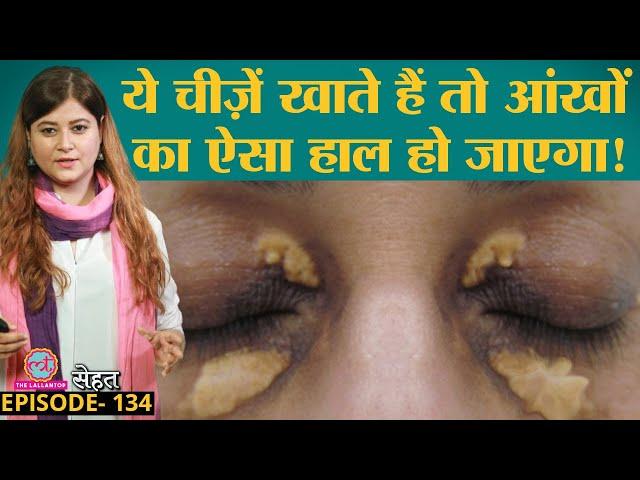 आंखों के पास पीले चकत्ते पड़ जाएंगे अगर ये गलतियां जारी रखीं | Xanthelasma|Cholesterol|Sehat ep 134