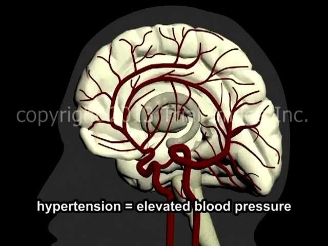 What Is A Stroke? - Narration and Animation by Dr. Cal Shipley, M.D.