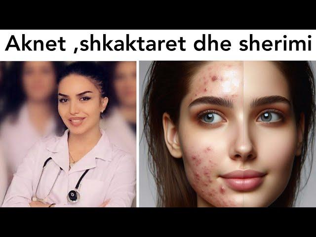 AKNET | Si sherohen aknet | Maska per fytyre #maska #fytyre #acne #blackheads #lekura #acnetreatment