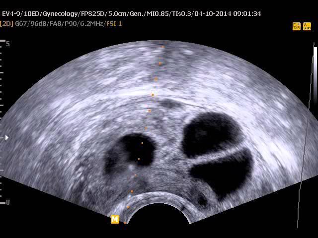 IVF - OOCYTE PICK UP PROCEDURE - PART 1