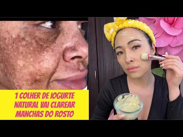 Como Eliminar Melasma e deixa pele lisinha com iogurte Natural