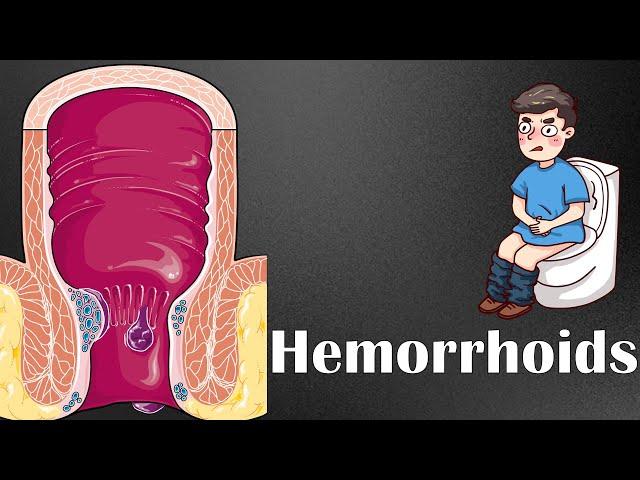 Hemorrhoids :- Types, Causes, Risk Factors, Signs & Symptoms, Diagnosis, & Treatment