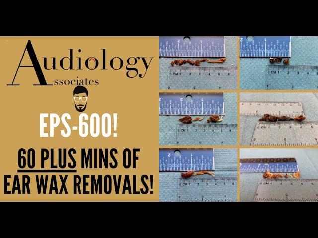 60 + MINUTES OF EAR WAX REMOVALS - EP600