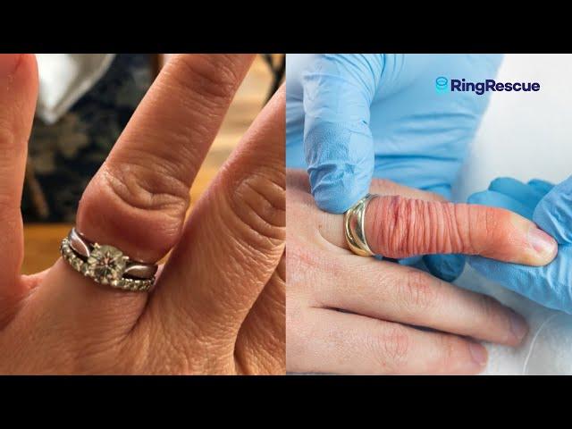 ANGRY FINGER Stuck Ring Removal Using The Ring Rescue Compression Device