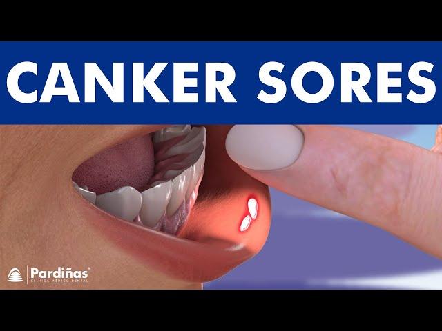 CANKER SORE - Treatment and mouth ulcer causes ©