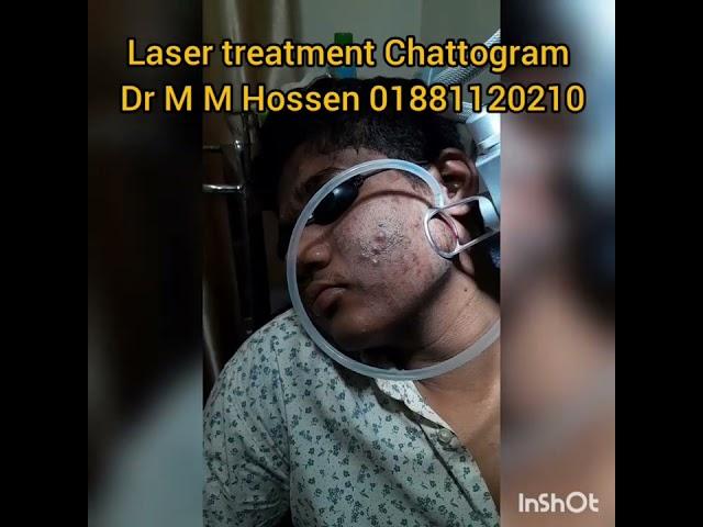 ব্রণ,ব্রণের দাগ,পোড়া দাগ,আঘাতের দাগ Acne,Acne Scar,Pimple, Scar CO2 laser treatment in Chattogram