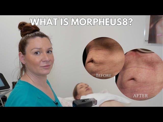 What is morpheus8 treatment? Myths and facts about Morpheus8 celebrity treatment!