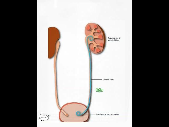 Xray - Bilateral DJ Stent insitu