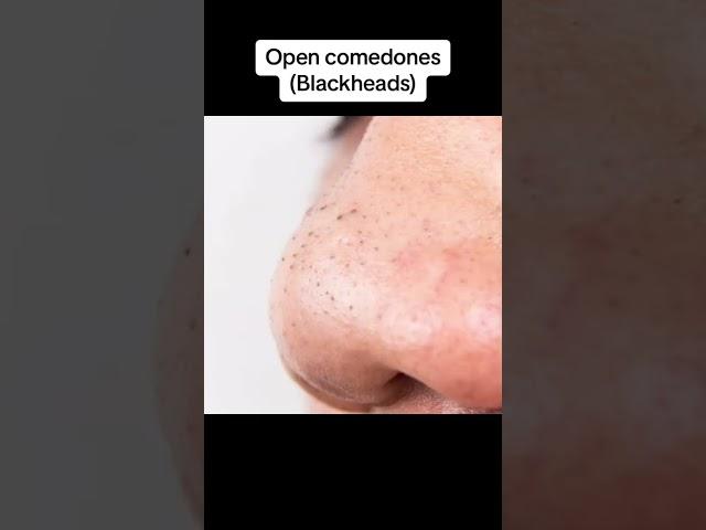 NEW Blackheads removal Dm on instagram for any queries Presence of white/blackheads is called comedo