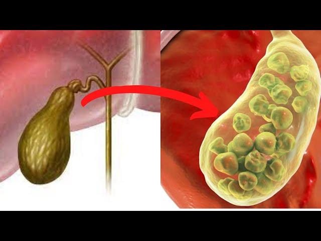 Warning Signs and Symptoms For Gallbladder Disease