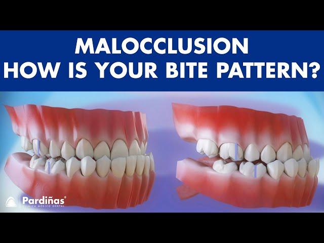 Malocclusion - Bite patterns ©