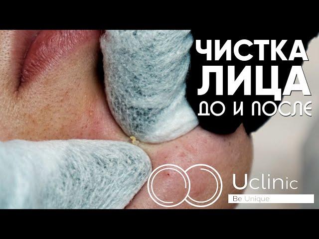 Чистка лица | Показываем процедуру | До и после