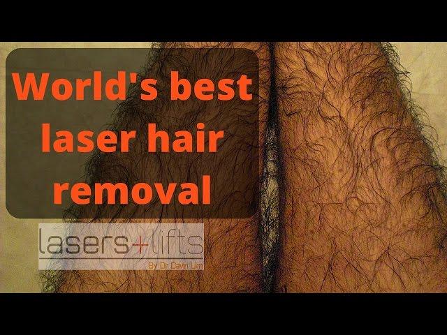 World's best hair removal laser