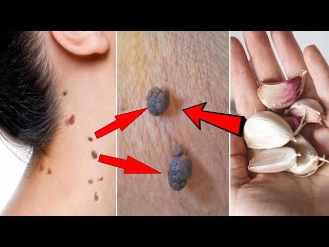 Remove skin tags in 1 night |  Amazing Skin Tag Removal Remedies |  How to remove skin tags.