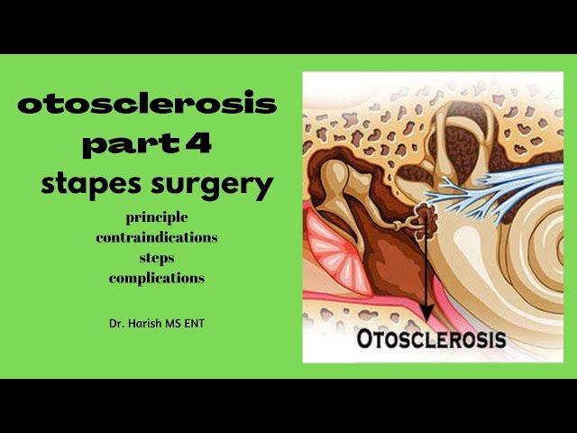 otosclerosis part 4/4 | stapedectomy | principle, steps, complications | MBBS - ENT