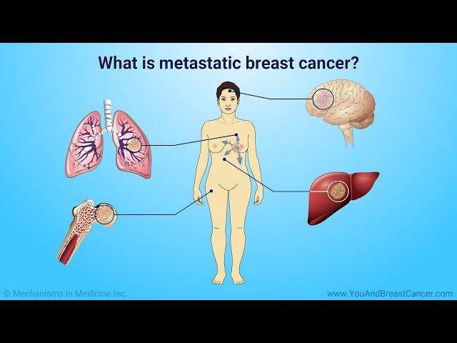 Understanding metastatic breast cancer