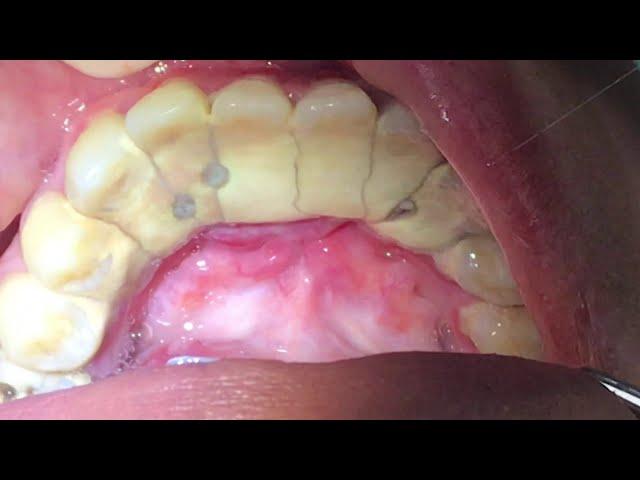 Houston Cosmetic Dentist...Worst Tartar I have seen! Watch how we remove it...