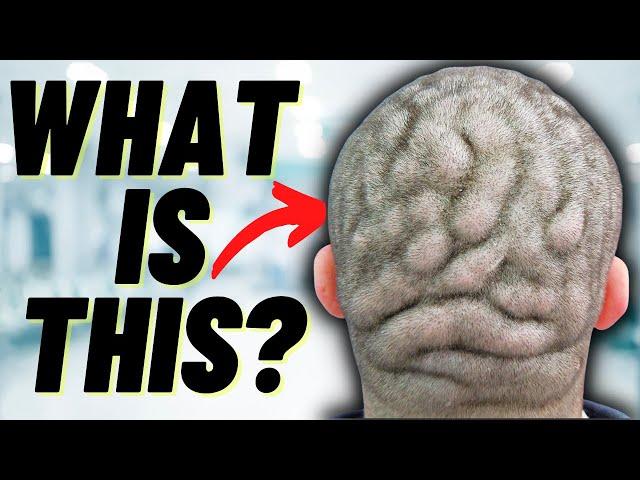 DOCTOR EXPLAINS CUTIS VERTICIS GYRATA | A condition which causes folds in the scalp (plus PHOTOS)