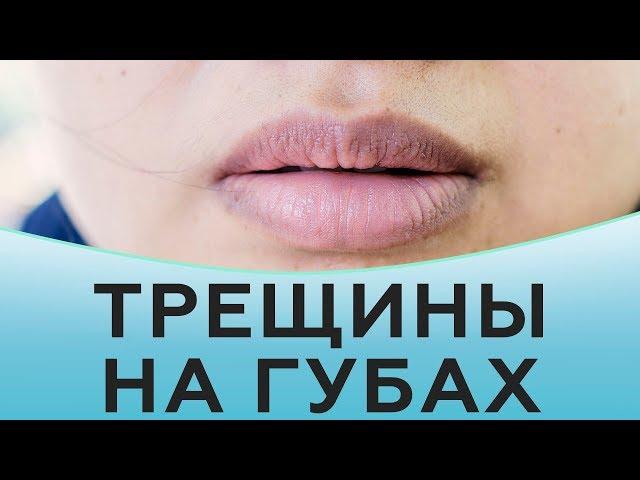 Трещины на губах. Как избавиться от трещин на губах