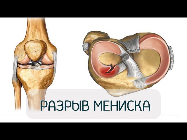 Травма, разрыв мениска. Оперировать или лечить?