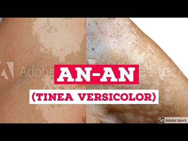 An-an : Sanhi, Sintomas At Gamot Para Sa Tinea Versicolor