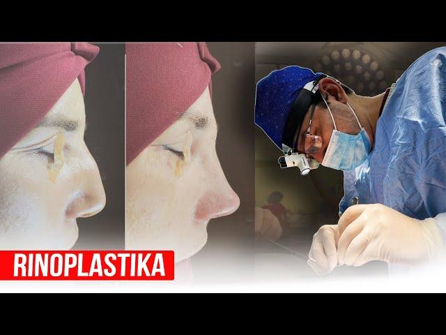 Rinoplastika