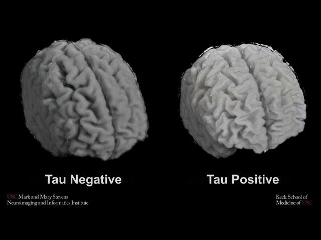 HABS T1 MR Amyloid Tau negative/positive comparison with Hippocampal atrophy